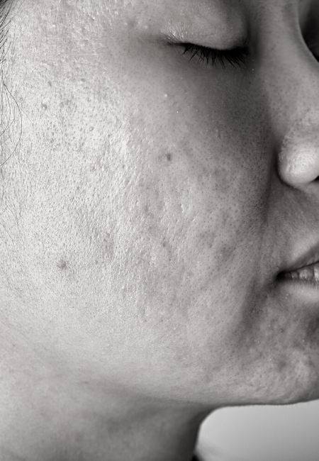 acne scars